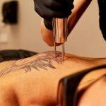 Tattoo Removal