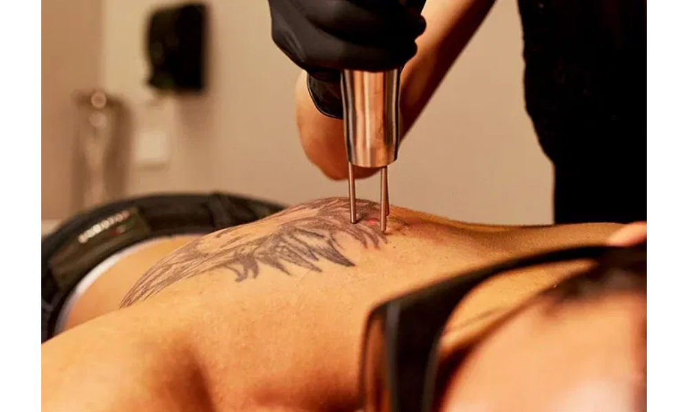 Tattoo Removal
